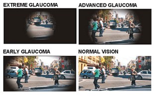 Glaucoma 01